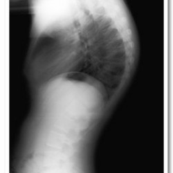 Pre-operative Thoracic Kyphosis (85 deg)