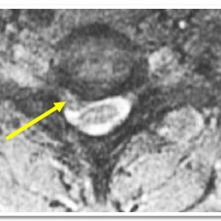 Preoperative MRI Demonstrating C5-6 Disc Herniation