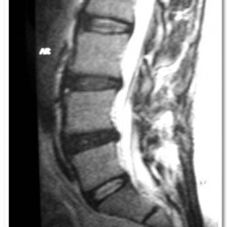 Pre-operative MRI - 2 level Degenerative Disc Disease