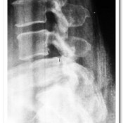 Pre-operative X-ray