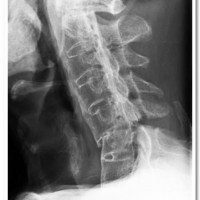Pre-operative X-ray demonstrating 
Cervical 5-6 (C 5-6)
fracture dislocation causing 
spinal cord compression