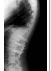 Post-operative Thoracic Kyphosis (40 deg)