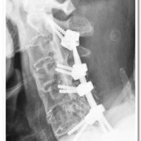 Post-operative X-ray 
showing reduction 
of the fracture 
dislocation and 
posterior fixation