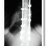 Post-operative Xray