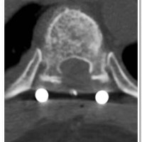 Post-operative CT Scan showing the adequate decompression performed