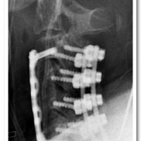Post-operative Xrays demonstrating adequate anterior and posterior decompression of the 
spinal canal and stabilization with 
anterior and posterior instrumented fusion