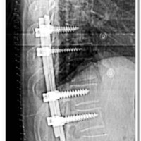 Post-operative X-ray demonstrating stabilization with pedicle screw fixation