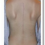 Post-operative