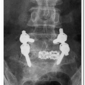 Post-operative X-rays