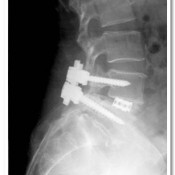 Post-operative X-rays