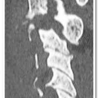 Pre-operative CT Scan of a patient with Hangman's fracture subluxation