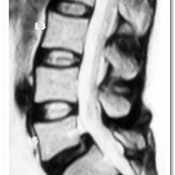 Pre-operative MRI