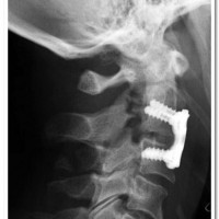 Post-operative X-ray displaying stabilization of the segment by anterior C2-3 fusion with bone-graft & 
anterior cervical plating