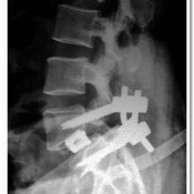 Post-operative X-ray