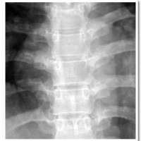 Pre-operative X-ray showing Thoracic seventh (T-7) vertebra