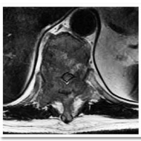 Pre-operative MRI demonstrating severe circumferential spinal cord compression at T-7