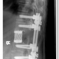 Post-operative X-ray showing excision of T-7 vertebral body (T-7 Corpecomy) & reconstruction of the spine with cement filled cage and posterior pedicle screw instrumentation